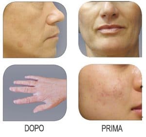 Silk'n Revit Microdermoabrasione