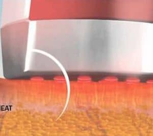 Silk'n Bellissima IMETEC FX Reju